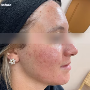woman before microneedling