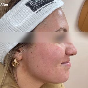 woman after microneedling for acne scars