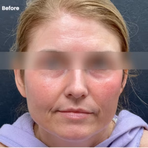 woman before rf microneedling