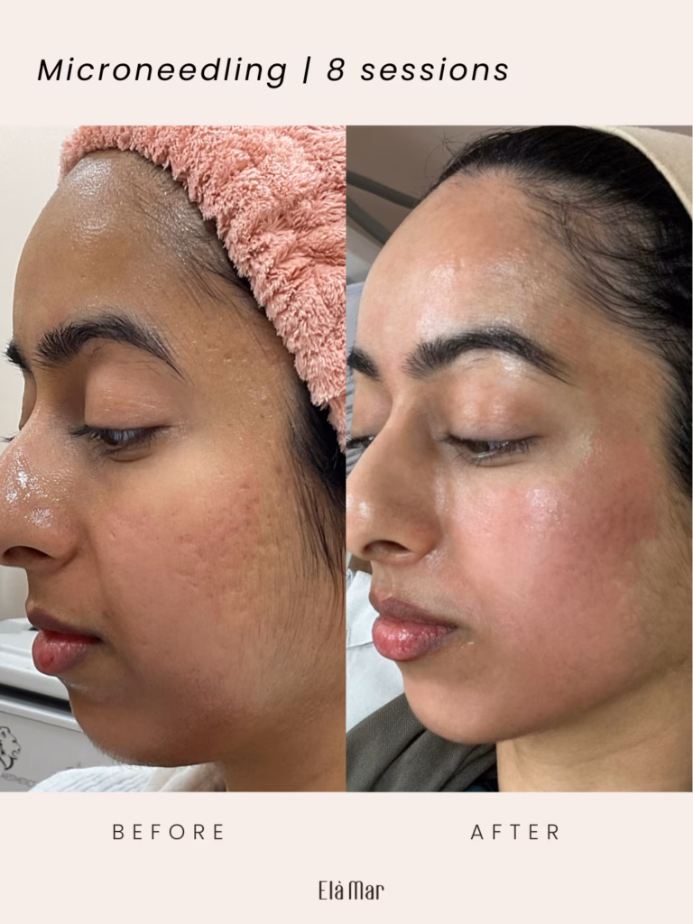 microneedling nashville